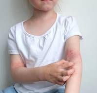 Childhood Atopic Dermatitis and Risk of Non-Atopic Comorbid Conditions